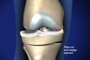 orthopedic-knee-realignment-open-wedge-osteotomy_300